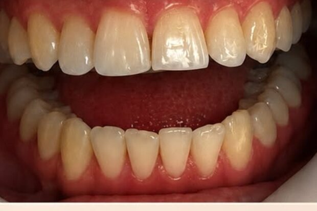 Sorriso antes do clareamento dental, com tom amarelado