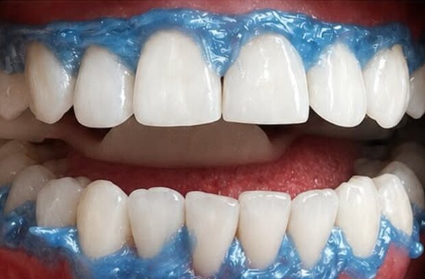 Sorriso depois do clareamento dental, visivelmente mais branco